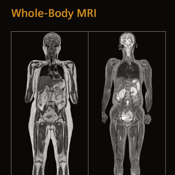 whole-body-mri
